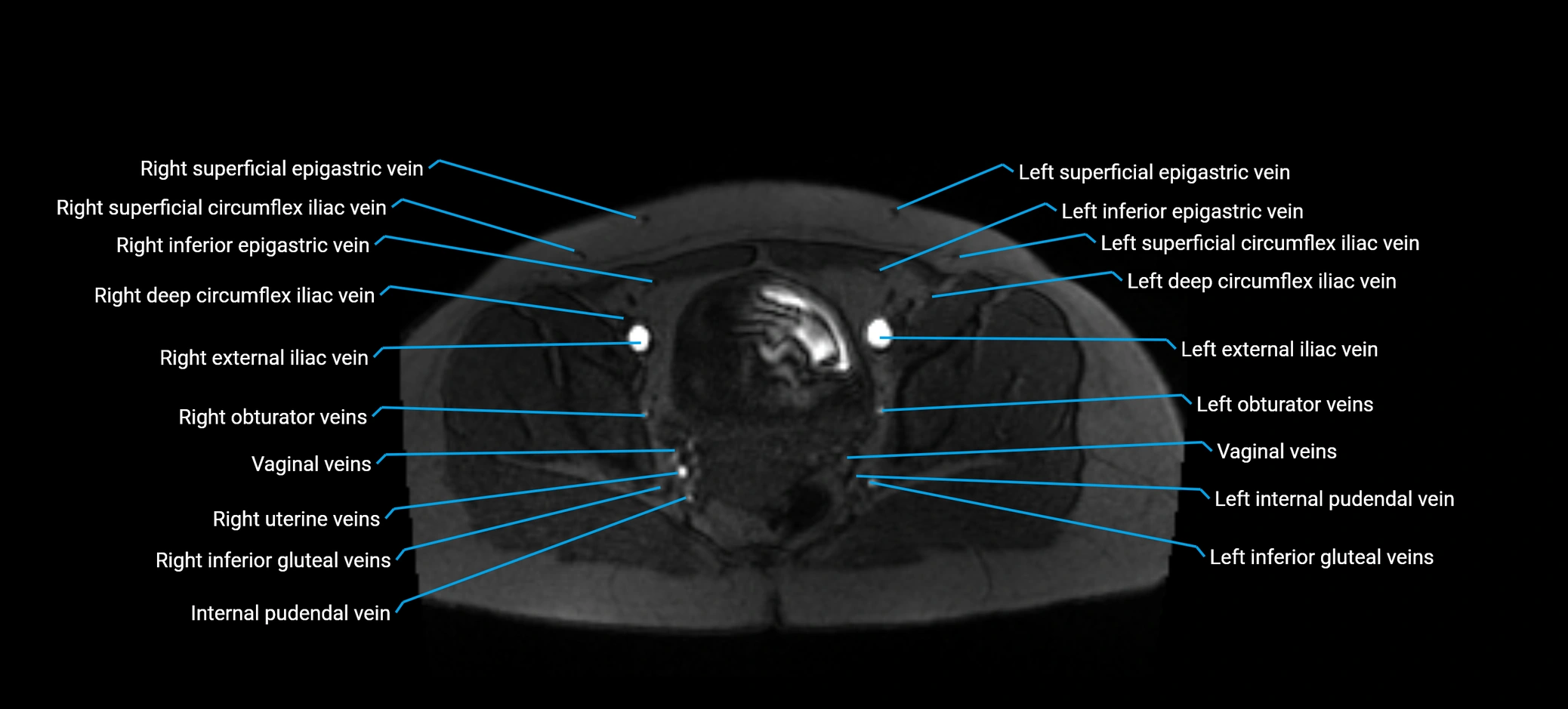 MRV abdomen pelvis & lower limb axial cross sectional anatomy labelled MRI image 169 (1).webp